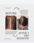 PRP Scalp Treatment