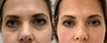 PRF Under-Eye Treatment