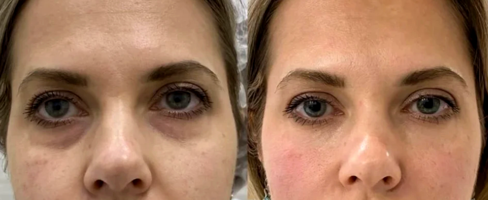 PRF Under-Eye Treatment
