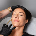 PRP Skin Treatment