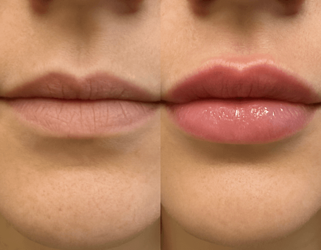 PRF Lip Rejuvenation